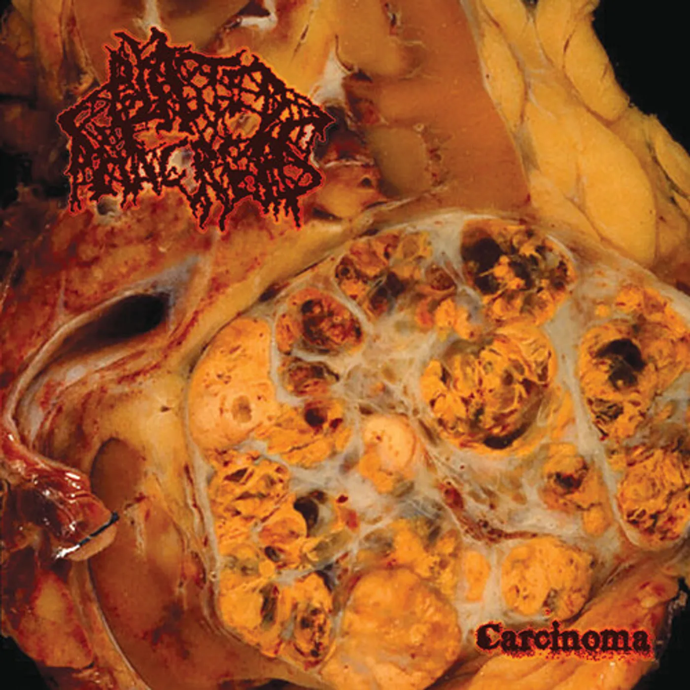 Blasted Pancreas CARCINOMA Vinyl Record